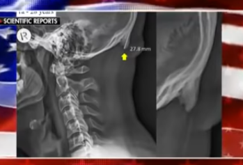 Children Are Growing Horns on the Back of Their Heads Due to Looking Down at Their Smart Phones